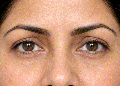 Close-up of dry, dehydrated skin texture around the eyes